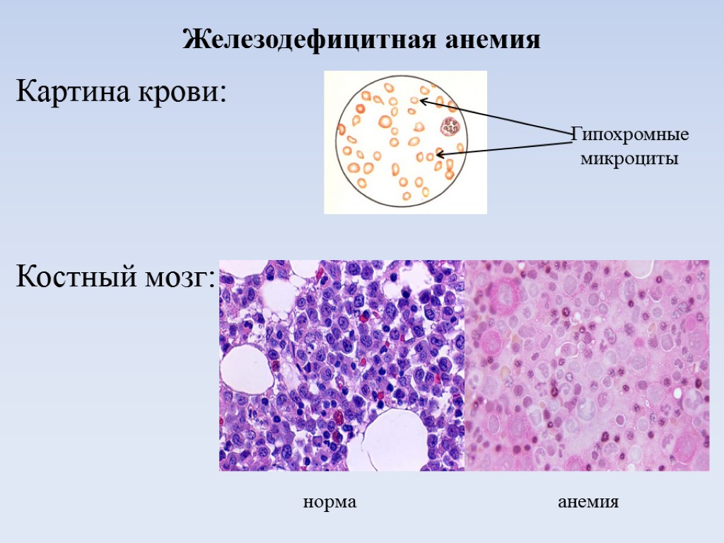 Фото анемия железодефицитная анемия